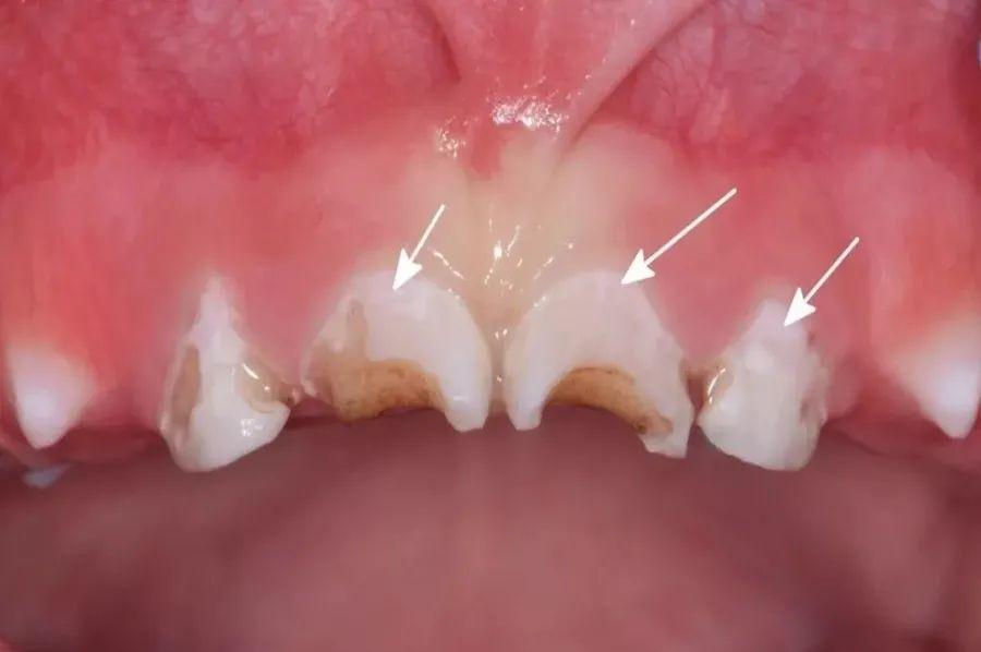 牙齿|不吃糖，孩子却满口烂牙！罪魁祸首竟是它，快看你家有没有
