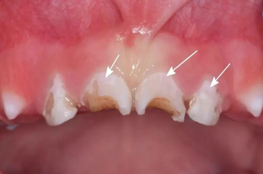 牙齿|不吃糖,孩子却满口烂牙!罪魁祸首竟是它,快看你家有没有