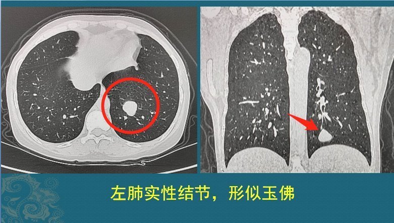  查出来|多数癌症刚查出来能吃能睡，一治疗就变差了，如果不治疗会咋样