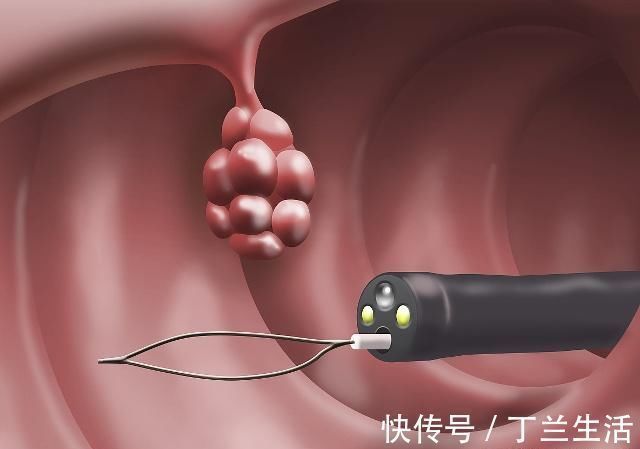 腹痛|上厕所有3种“异象”,可能是肠子里长了“它”,希望知道的不晚