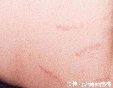 文儿|“怀孕后,身上有印记出现”有这信号,可能要长妊娠纹