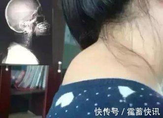 厨房|“十个颈椎九个包”,厨房中拿瓶醋,此法能治好,早知早受益