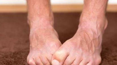 张医师|当血管堵塞时，脚部可能会发出信号，你若没有，表明血栓离你还远