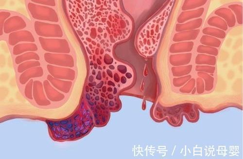 肉球|痔疮频繁出现肉球怎么办?一线专家在交流大会中分享妙招!