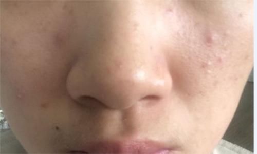 鼻子两侧挤出来的白色物质是什么 皮肤科医生一次性给你说明白!