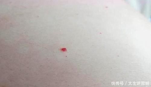 蜘蛛痣|身上突然长出这种小红痣,别大意,可能是某些疾病的预警信号