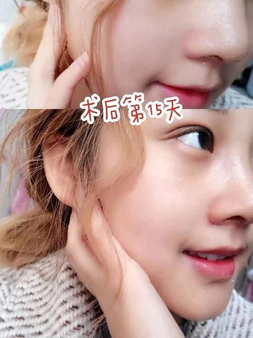 自体软骨垫鼻尖为什么会越来越低？