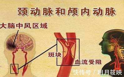 颈部|有颈动脉斑块的人还能跑步吗？斑块脱落会堵塞血管吗？