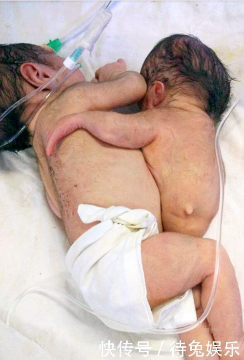 头次孕检查出怀有双胞胎,全家高兴,孩子出生后却把一家人吓懵了