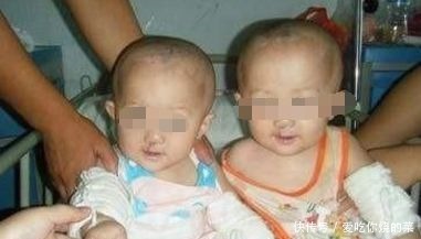 双胎|30岁孕妇怀双胎查出唇腭裂,不舍得打掉,看到宝宝全家乐开花!
