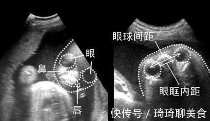 孕妇|孕妇做四维彩超,胎儿鼻子扁又大,胎儿也是有苦说不出啊!