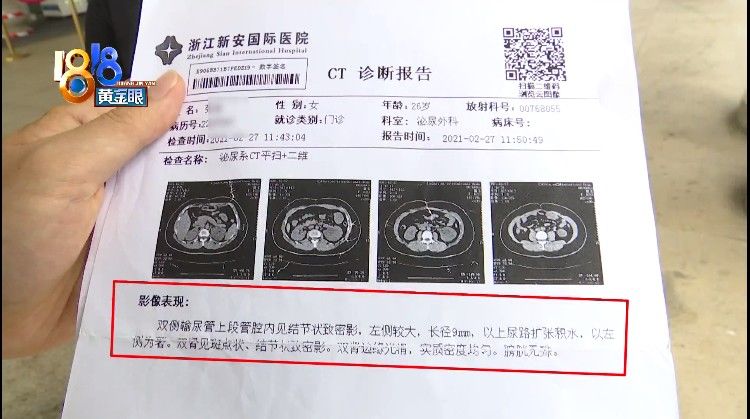 ct|术后小便一直出血，手术支架漏取一个