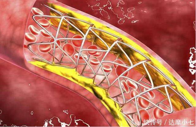 红酒|“软化血管”谣言骗了囯人30年,什么木耳、红酒都是胡扯