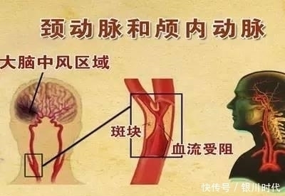 血管|颈动脉一旦被堵,这个部位反应最强烈,1种蔬菜汤,通血管消斑块