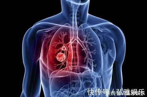 胸片|55岁男子,体检正常5个月后查出晚期肺癌去世体检到底有何用