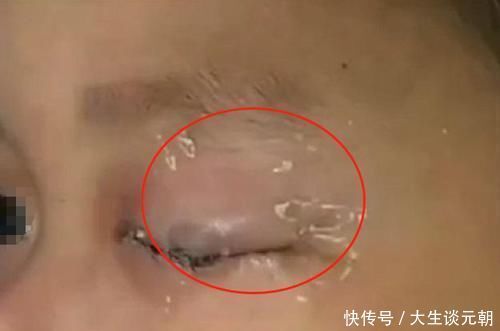 爸爸|儿子误将502滴入眼中,爸爸“教科书式”方法救了孩子,医生:高明