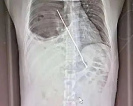 男子|怎么吞下去的？男子被20厘米烤肉簽穿肺…