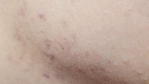 结节|结节、息肉、囊肿、增生，哪个是癌症“先兆”？一文给你说清