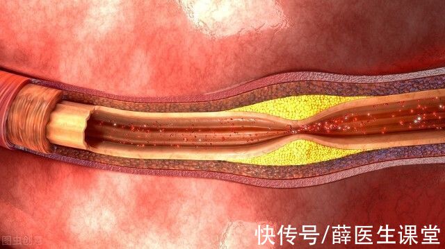 合并心|提醒：10类高血压患者易发生意外，若你符合，赶紧调整