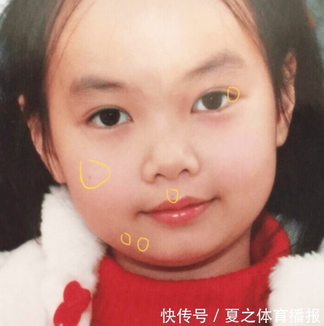 脖子|宝宝身体这些部位有痣,是“有福气”的信号,看看你家娃中了没?