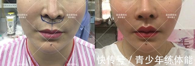 拉皮 小拉皮术后6个月,让她从老阿姨逆袭小姐姐!