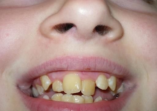 牙医|孩子换牙齿,新长的牙齿却是歪的,可能是家长这些没做好