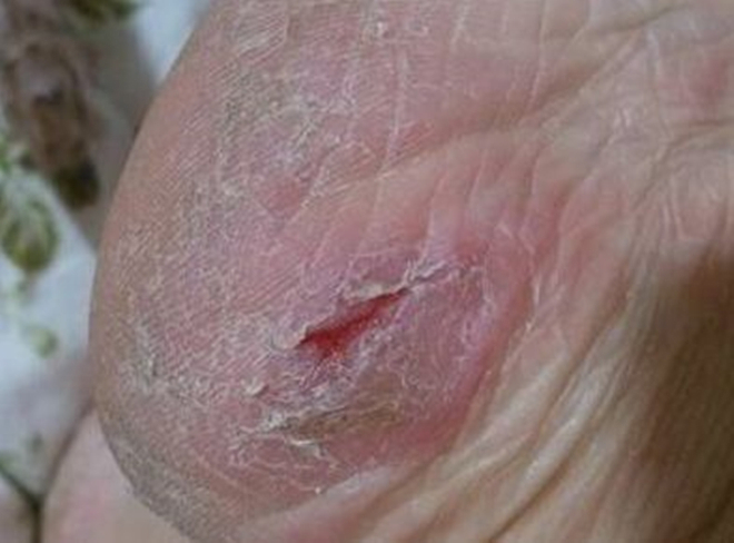 裂田|脚后跟的“裂田”,是因为缺水吗并非那么简单,劝你心里有个数