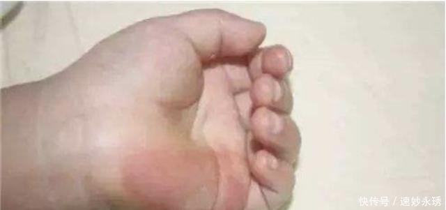 医生|幼儿烫伤频发,医生建议重视安全防护,你做得如何?