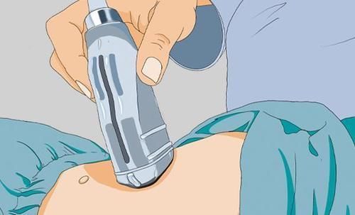 b超|做B超时,总会在身上涂点黏黏的液体,是啥东西?有什么用处?