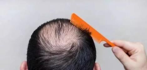 脫發|經常脫發的人，多半是缺少2種元素，及時補充后，發量會慢慢變多
