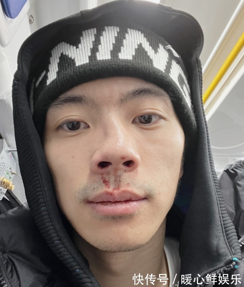 刘东|CBA变武斗场?两大名将中招,一个鼻梁3处骨折,一个嘴巴缝12针