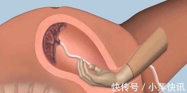 胎儿|“我都生完半小时了,你还掏什么”产妇怒斥男医生,只因下面疼痛