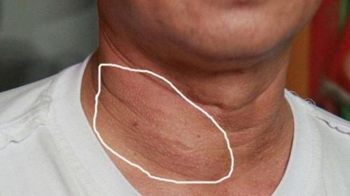 淋巴结转移|20多岁得甲状腺癌能活50年吗,医生:注意4件事,可能会活的更久