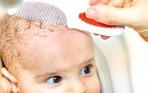 宝妈|你家宝宝头上有舅舅屎吗?这样处理不伤头皮,赶紧get起来