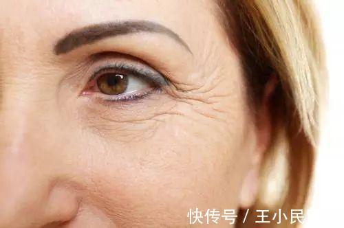 眼膜 王小民教授:为什么眼周很容易出现皱纹?