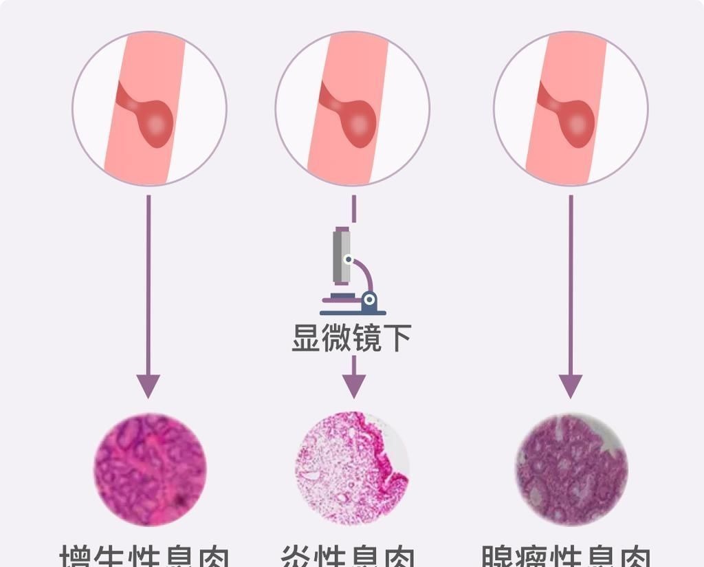 卵巢囊肿|结节、息肉、囊肿是癌症先兆吗?北肿专家们说出了真相!