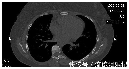 肺结核|23岁女孩癌细胞全身扩散,一年抗癌出奇迹