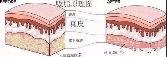 原理 吸脂手术原理是什么？直击腹部吸脂手术全过程