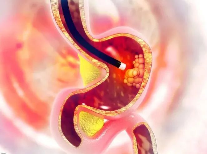 癌症|人人必知的8种常见癌症筛查