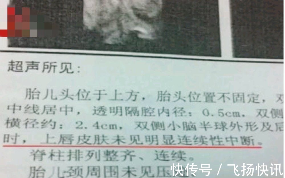 检查|为何在孕期正常吃叶酸,胎儿还会“唇腭裂”?孕妈别耍小聪明了