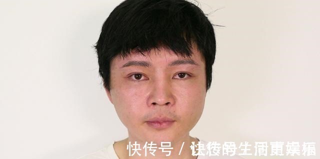 面部 32岁小伙子拉皮真实记录，术后30天效果很“惊艳”！