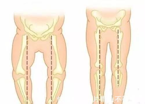 膝关节|引起孩子罗圈腿的原因竟然是特别是第二条，家长一定要注意！