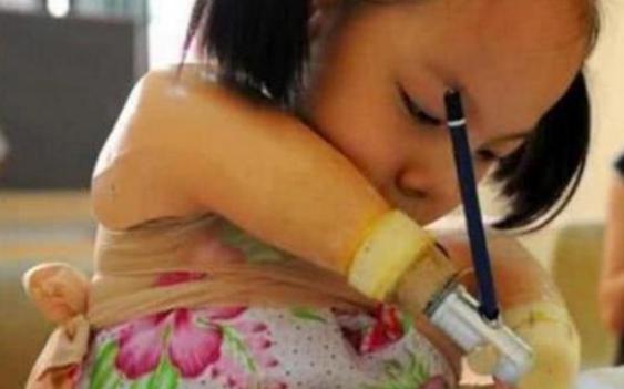 胎儿|孕检发现胎儿“没有四肢”,宝妈不顾阻拦坚持生下,如今咋样了