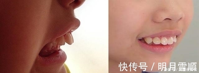 妈妈|17岁孩子长尖牙,妈妈以为是假的,亲手摸过后吐槽:像“吸血鬼”