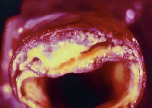 动脉粥样硬化|发现“动脉斑块”,还能逆转或消失吗心脏医生给出靠谱答复