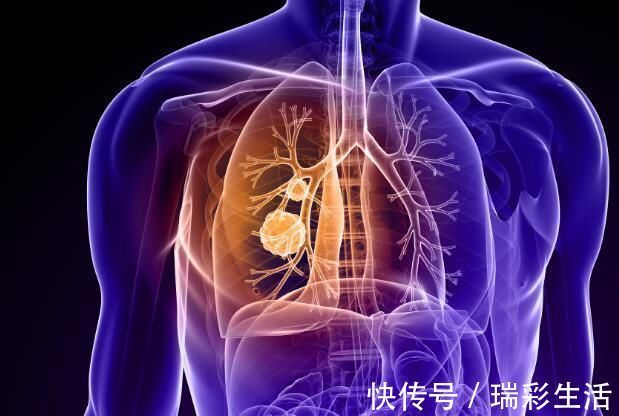 癌细胞|出现这种咳嗽, 别以为是感冒问题, 它可能是肺癌发出的信号!