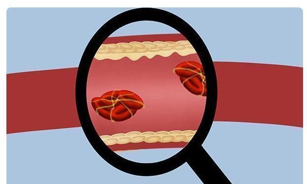 血管|忠告：2味调料尽量少吃，可能是血栓的“温床”，常吃血管受不了