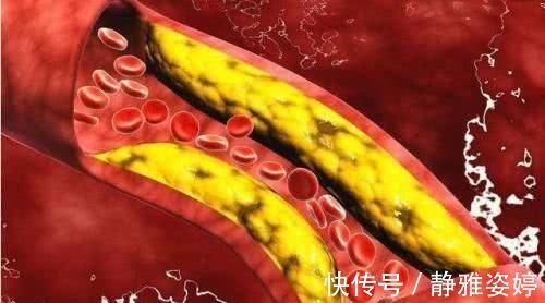 胆固醇|一旦查出高血脂，尽量多吃这几种食物，血脂或会慢慢降下去