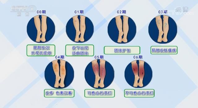 中老年人|别让“蚯蚓”爬上你的腿