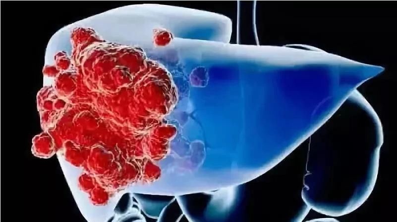 医生|54岁女子,肝癌晚期,化疗2次离世,医生怒斥:冰箱1物伤肝又索命